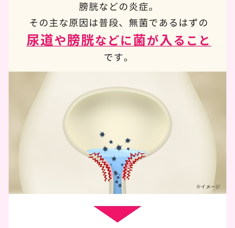 膀胱などの炎症。その主な原因は普段、無菌であるはずの尿道や膀胱などに菌が入ることです。